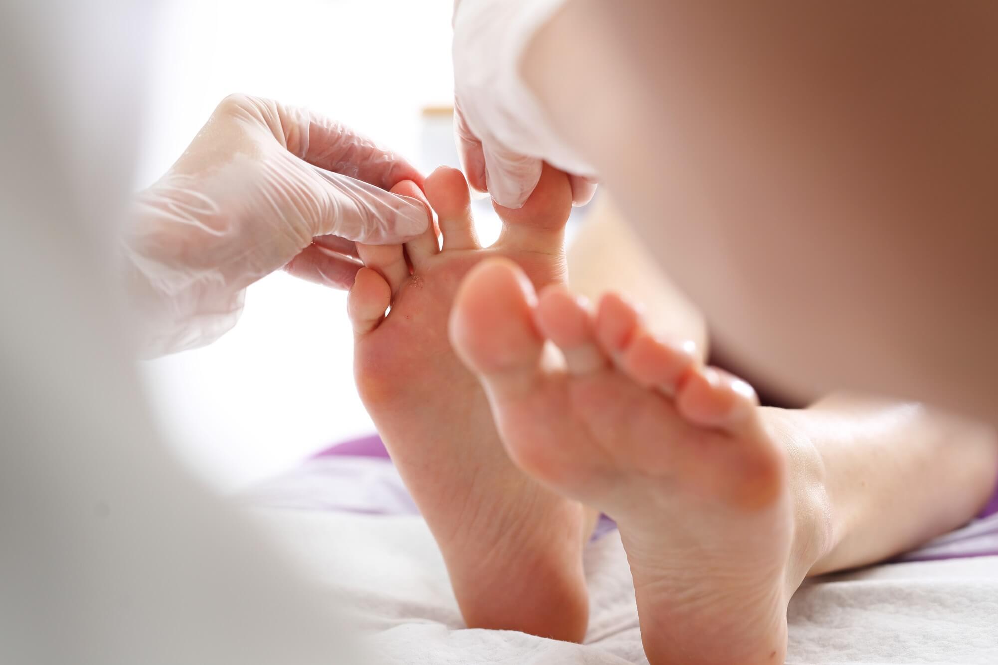 how-to-treat-athletes-foot-family-foot-ankle-centers