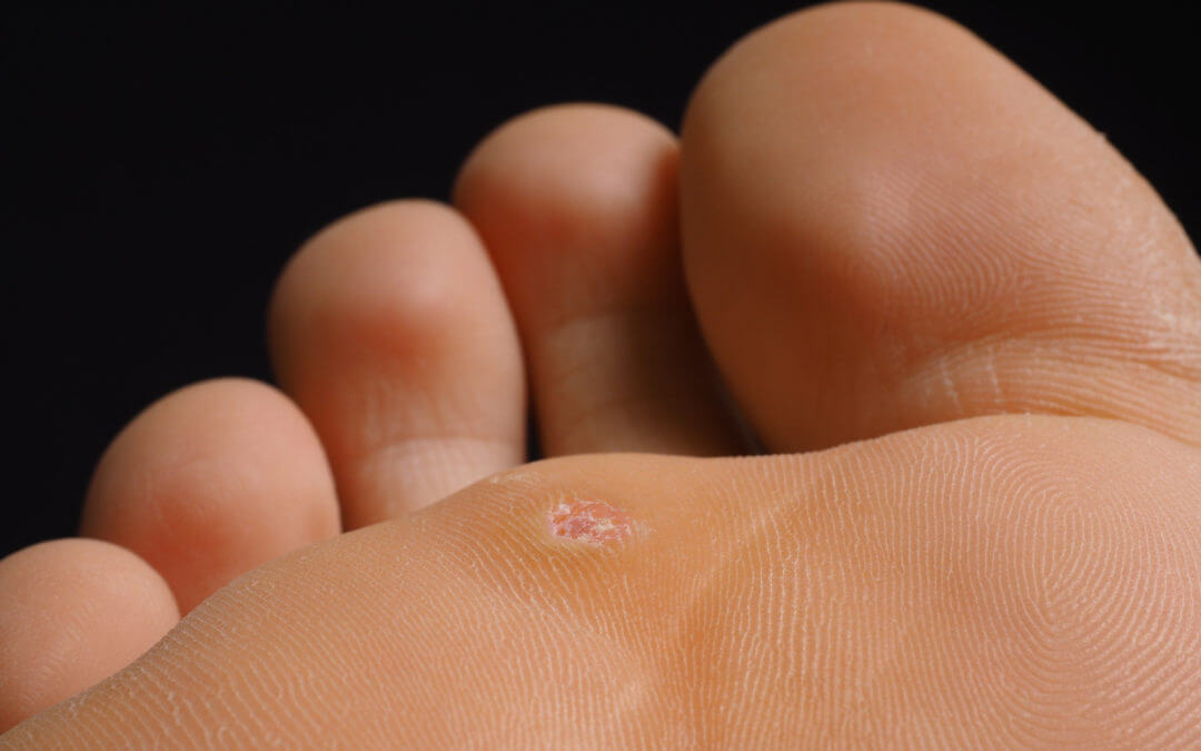 Wart on foot with black center - printreoale.ro - Papilloma foot removal