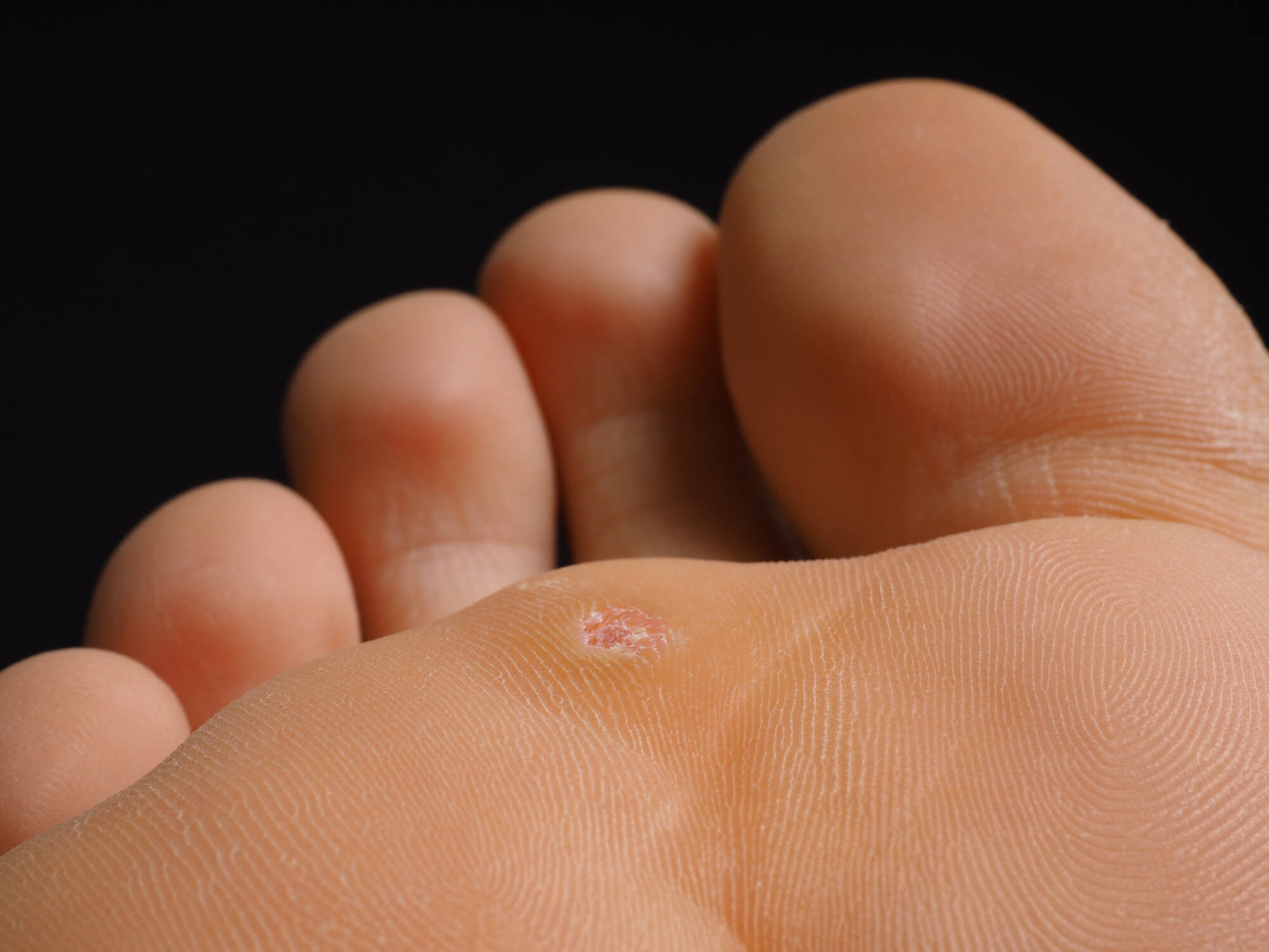 wart on the foot