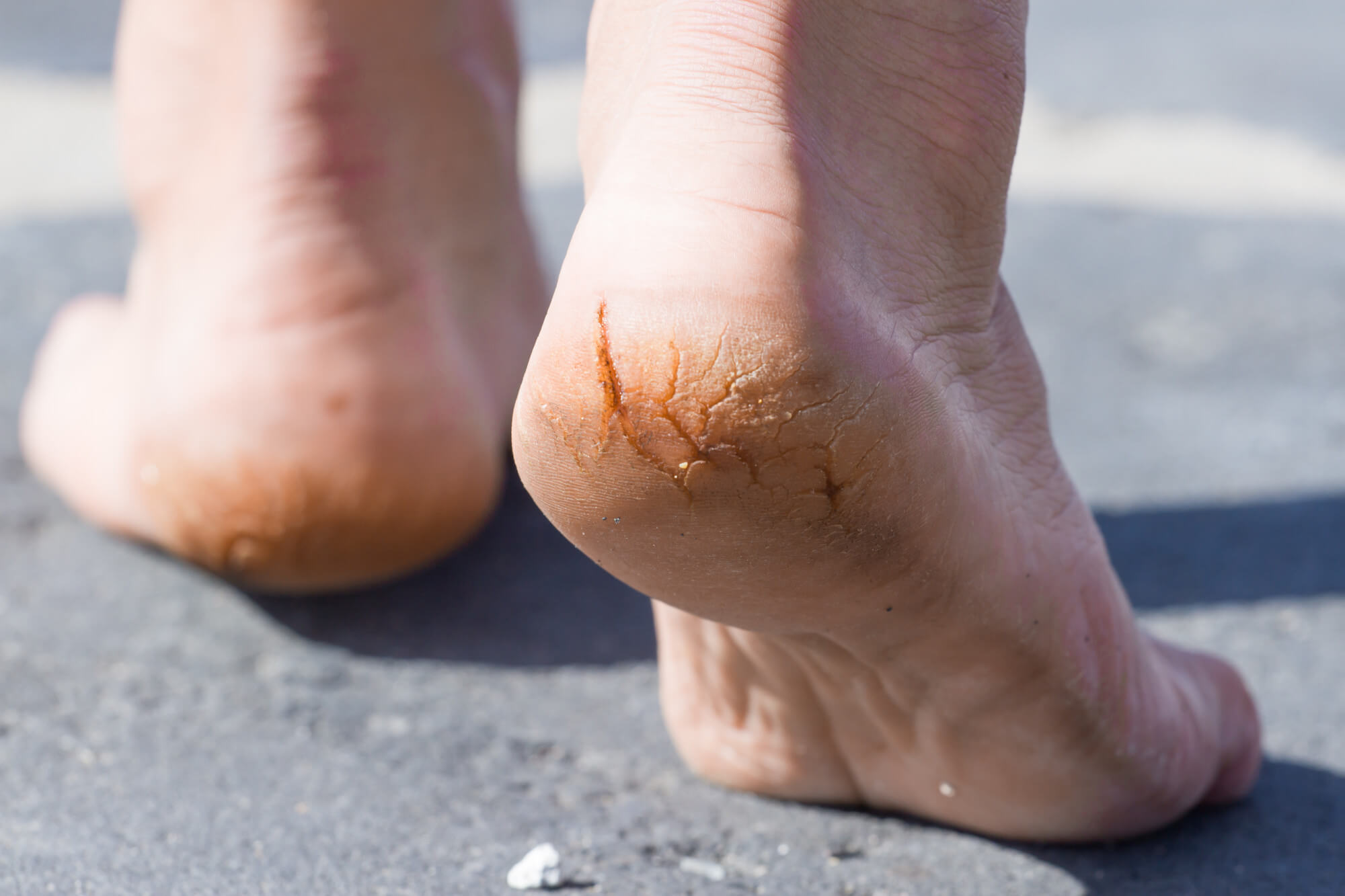 Cracked Heels | Dry Cracked Heels Treatment | Heavenly Foot Care