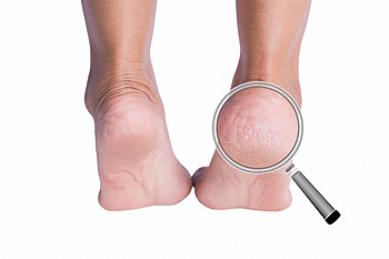 Possible Relief From Cracked Heels