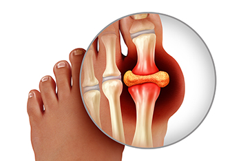 Pediatric Gout - Family Foot & Ankle Centers