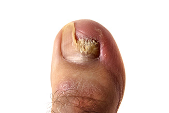 Unsightly Toenail Fungus