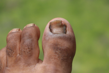 Fungus and Other Causes of Thick Toenails