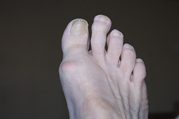 Relief Options for Morton’s Toe