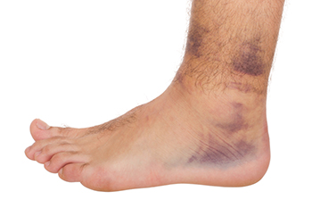 Three Types of Ankle Sprains and Their Causes