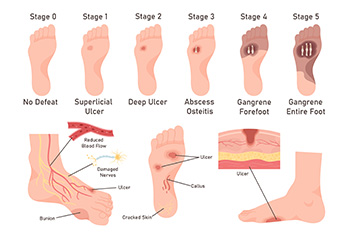 Diabetic Foot Ulcers Cause Foot Pain