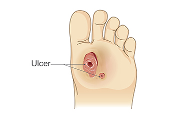 Non-Diabetic Foot Ulcers