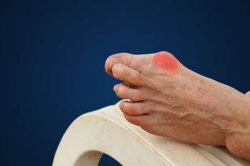 Bunions and Accompanying Symptoms