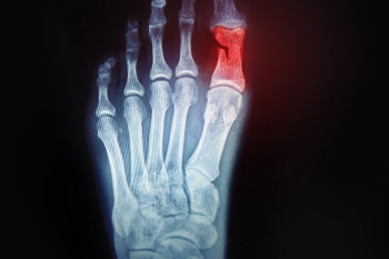 Causes and Symptoms of Toe Fractures