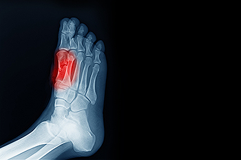 Sesamoiditis and the Role of Sesamoid Bones