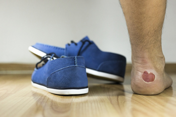 Causes and Types of Foot Blisters